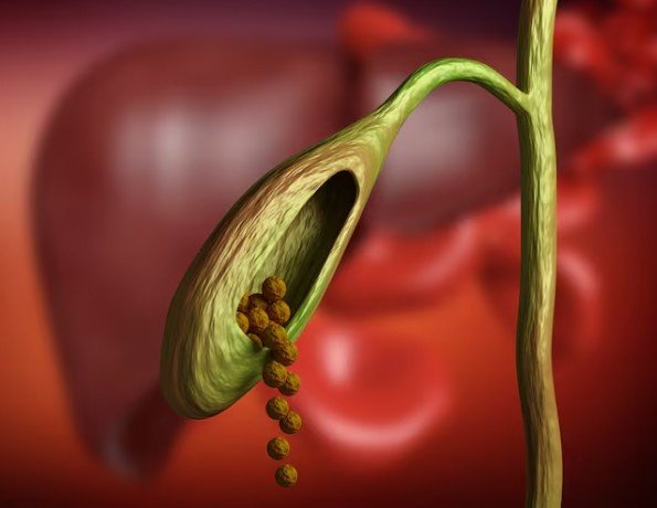 How does Dr. Kushwah’s Homoeopathic Clinic in Sector 50, Faridabad, approach gallbladder stone treatment?