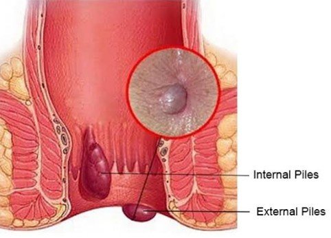 What are the Common Symptoms of Piles that Homeopathy Can Effectively Manage?