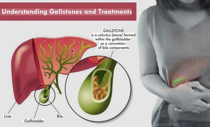 Who Can Benefit from Homeopathy for Gallbladder Stone in Faridabad at Dr. Kushwah’s Homoeopathic Clinic?